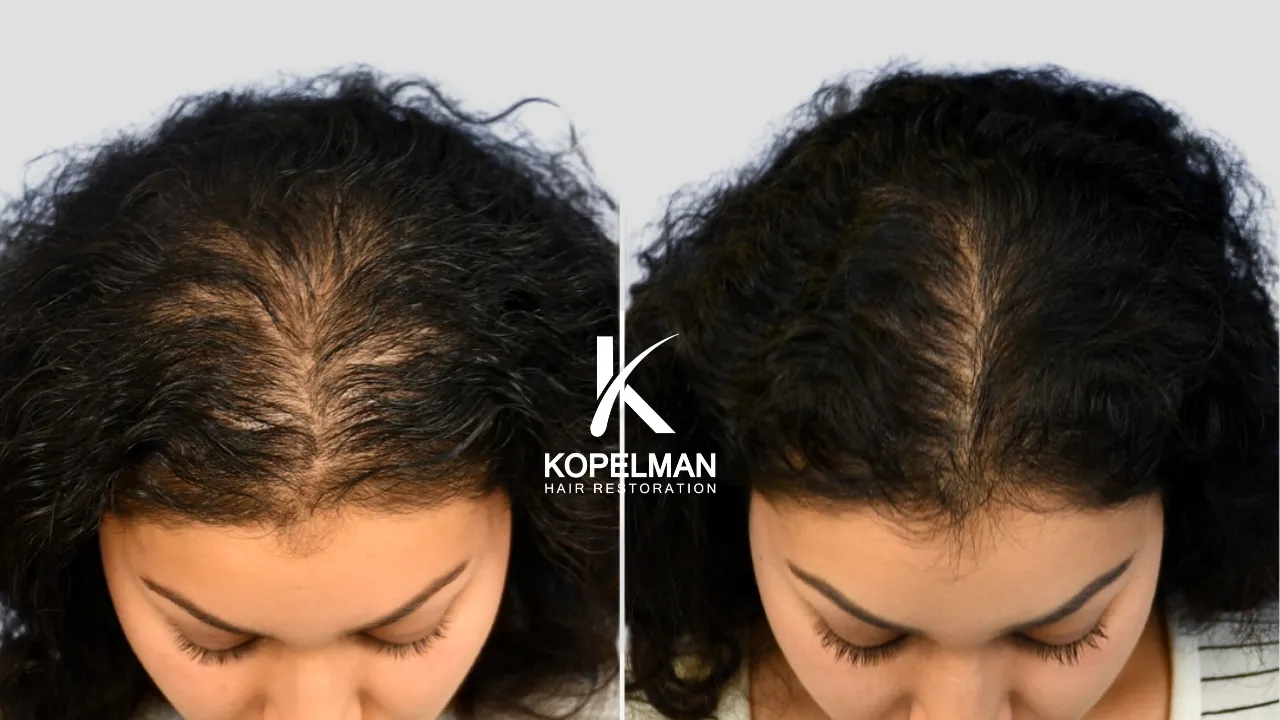 Mesotherapy Before and After _ female Hair Loss treatment 2