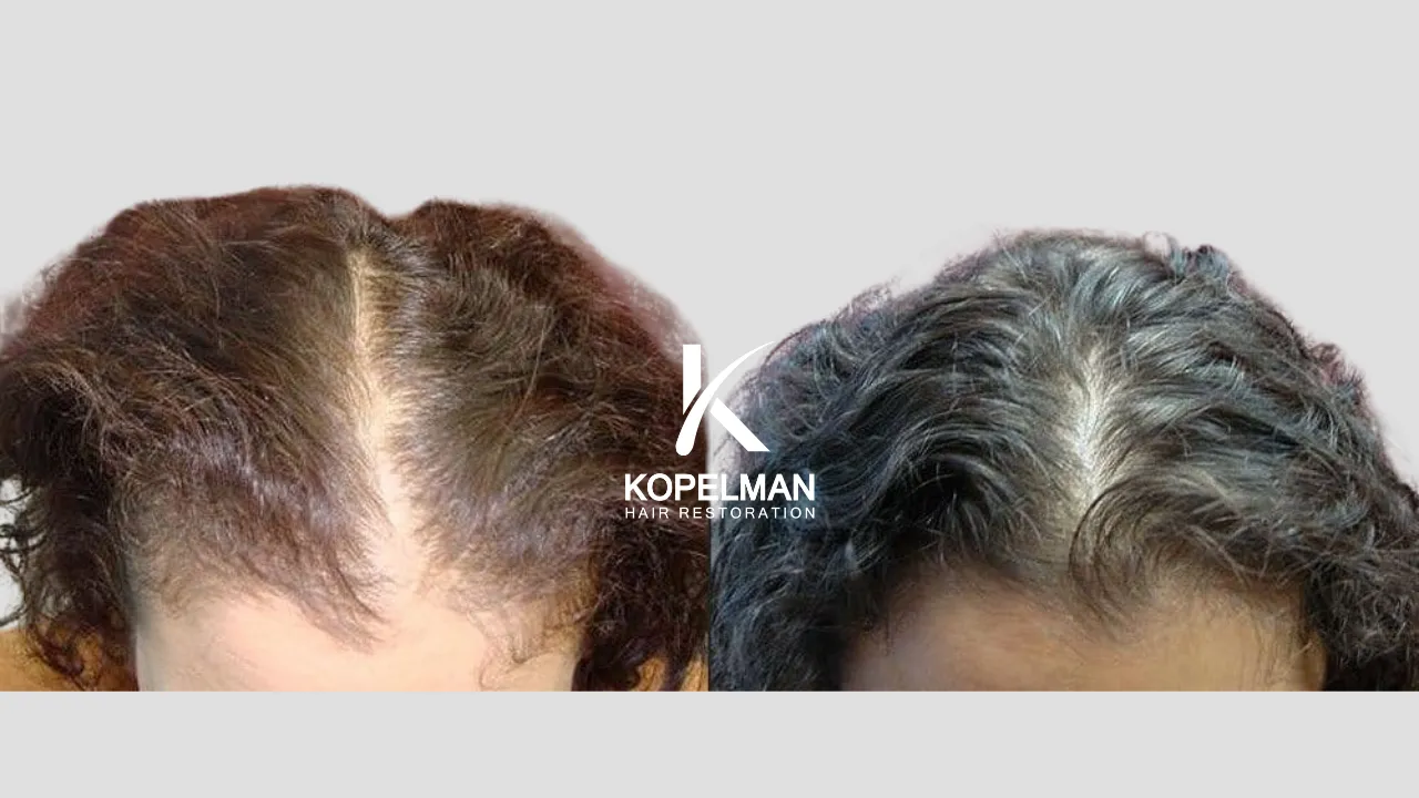 Mesotherapy Before and After _ female Hair Loss treatment