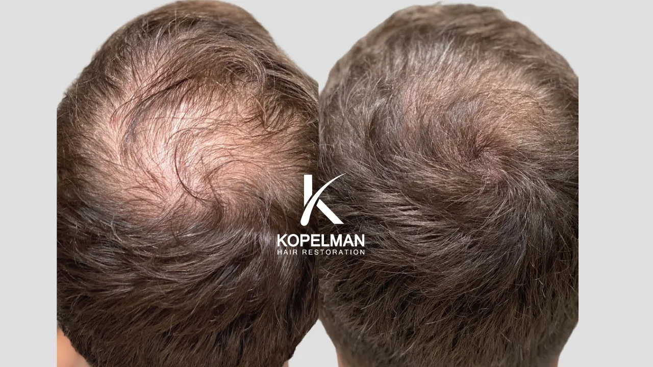 Mesotherapy Before and After for male hair loss crown