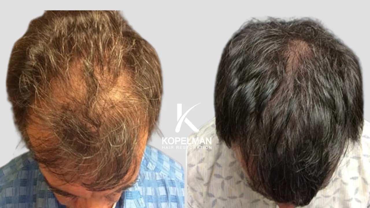 Mesotherapy Before and After for male hair loss