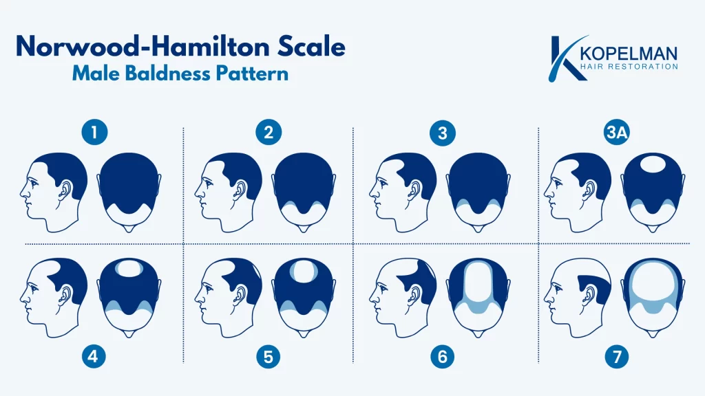 Norwood Scale Understand Baldness Stages And Treatments