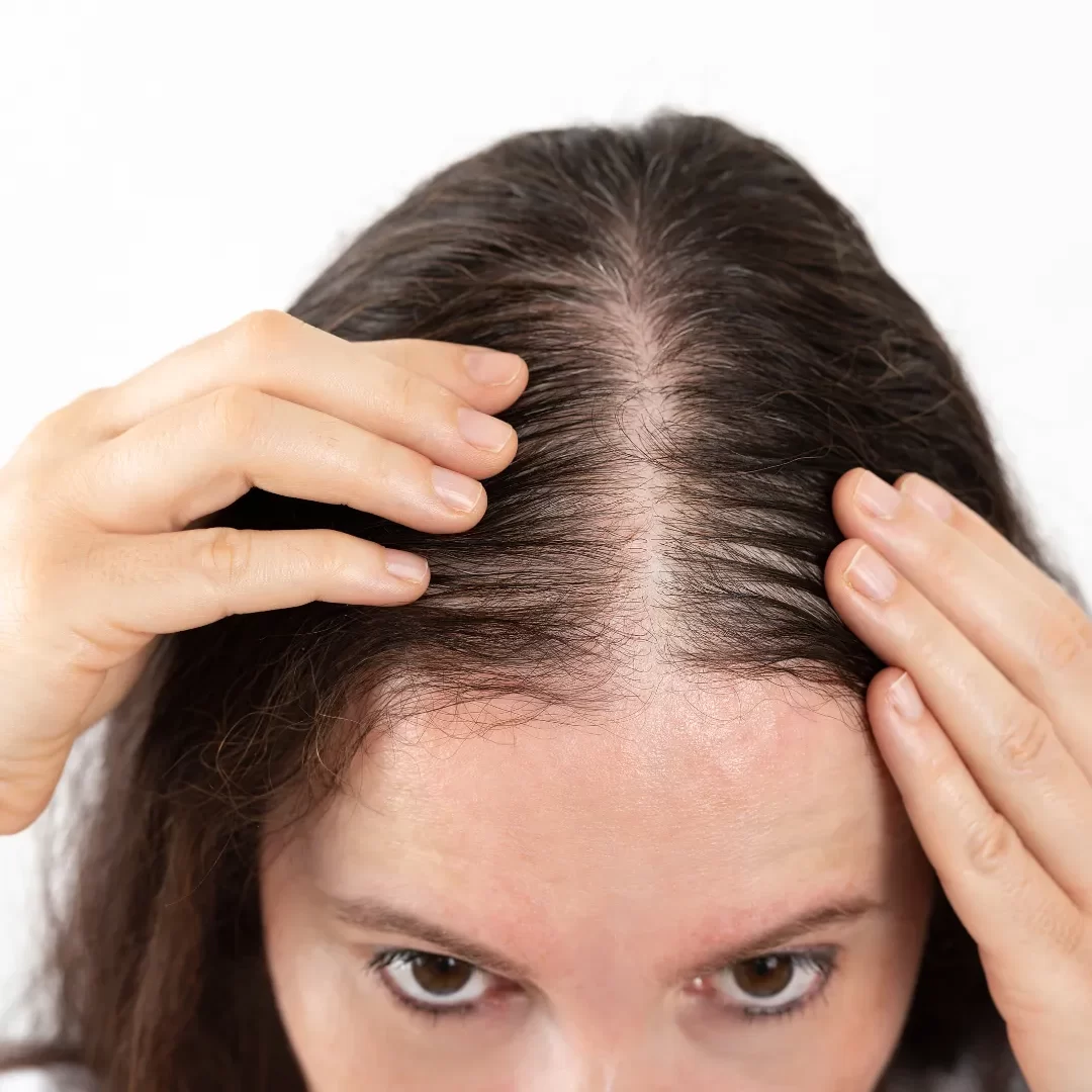 Hair Transplant with Fine Hair | Natural-Looking Results
