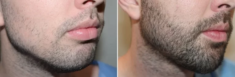 patient-126865-facial-hair-transplant-before-after-1-1200x396