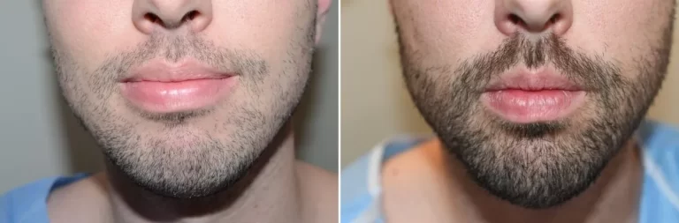 patient-126865-facial-hair-transplant-before-after-1200x396