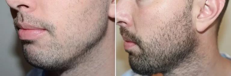 patient-126865-facial-hair-transplant-before-after-2-1200x396