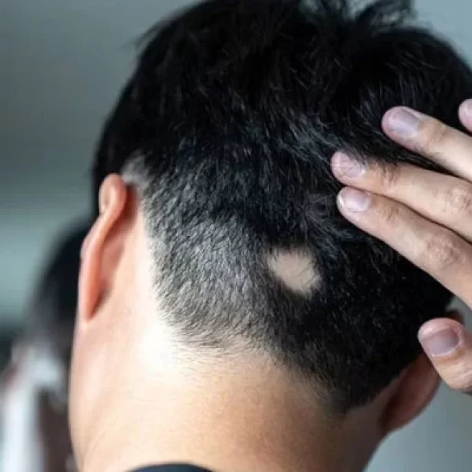 Steroid Injections for Alopecia: Types, Results & Risks Explained