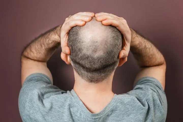 Bald Head Cure Proven Treatments And Expert Insights