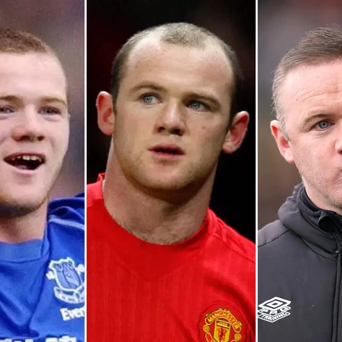Wayne Rooney Hair Transplant Costs, Methods, Results