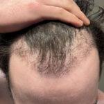 13-weeks-after-shaveless-fue