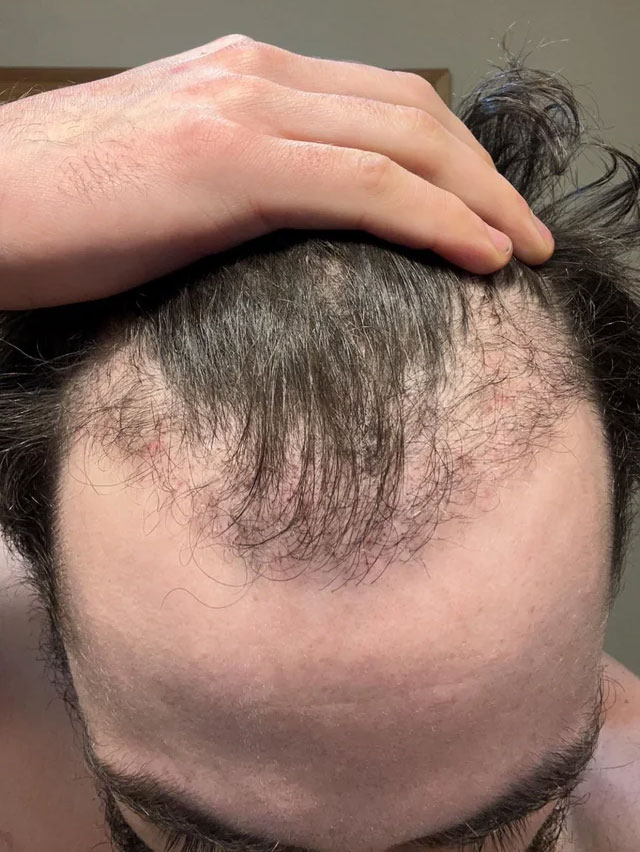 13-weeks-after-shaveless-fue
