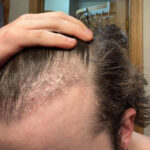 13-weeks-after-shaveless-fue2