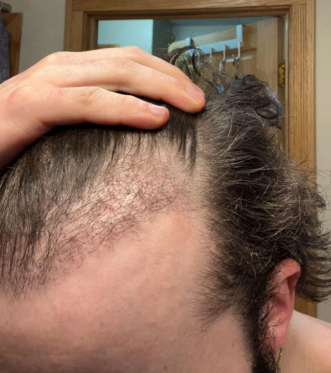 13-weeks-after-shaveless-fue2