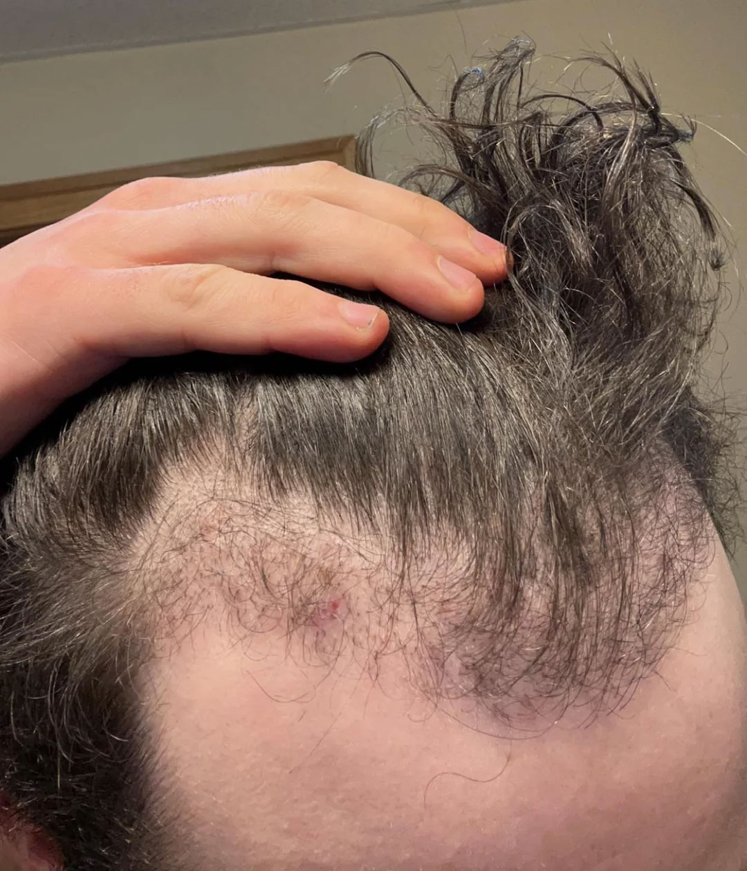 13-weeks-after-shaveless-fue3