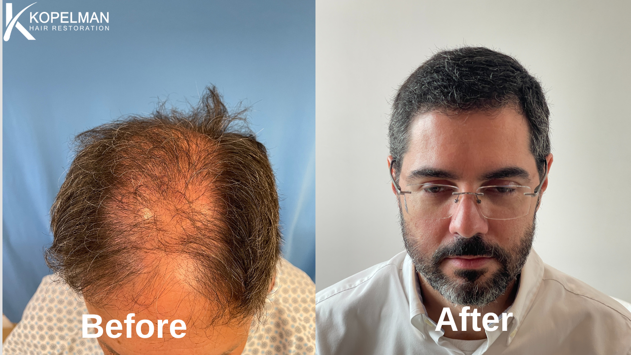 female-Patient-2-before-and-after-hair-transplant-front