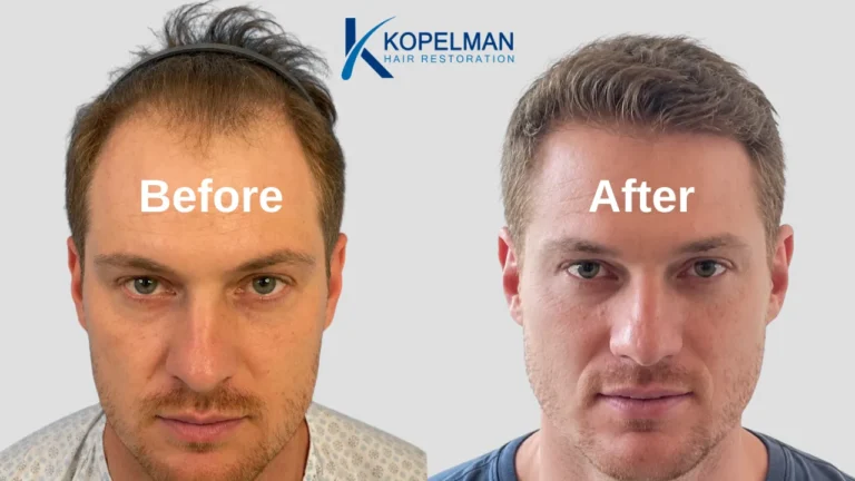 Hair Transplant Before and After (2)