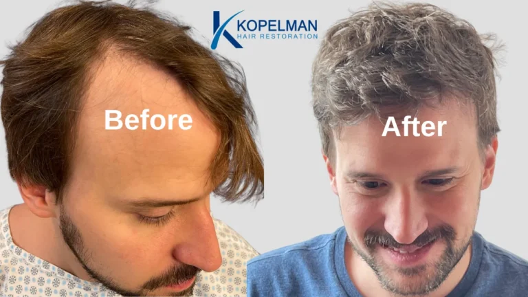 Hair Transplant Before and After (3)