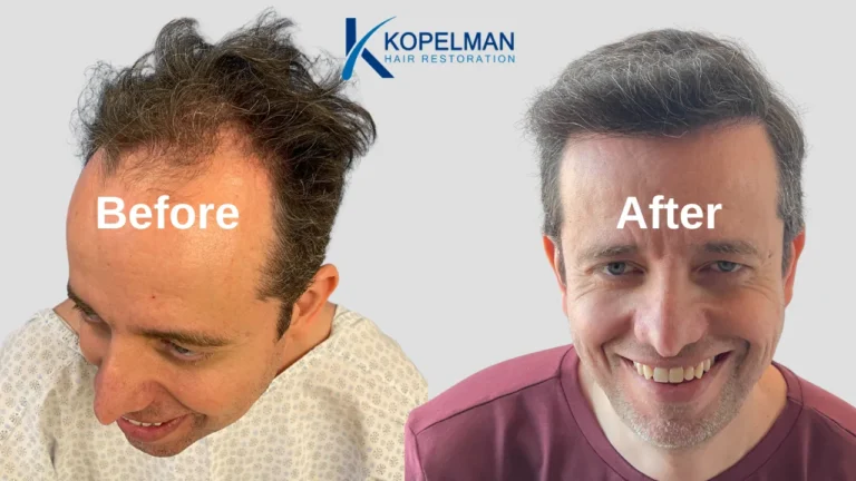 Hair Transplant Before and After (4)