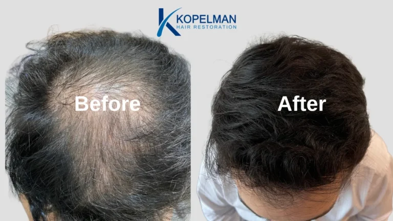 Hair Transplant Before and After (5)