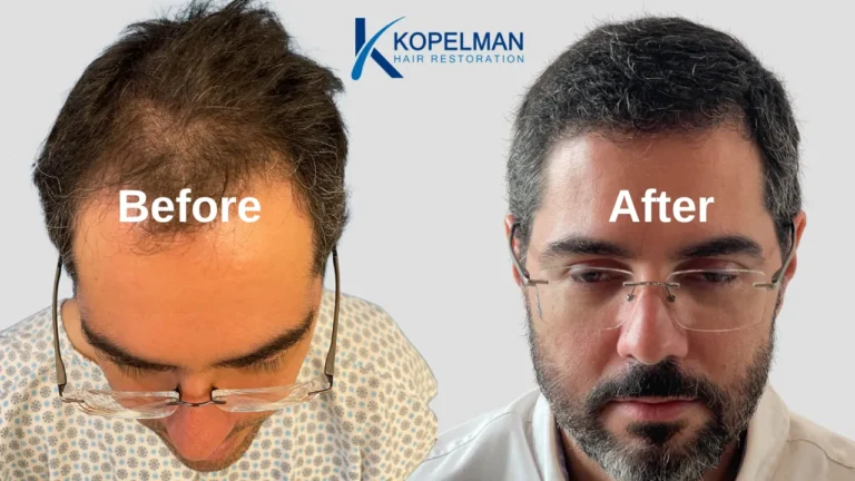 Hair Transplant Before and After (6)
