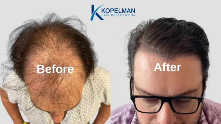 Hair Transplant Before and After